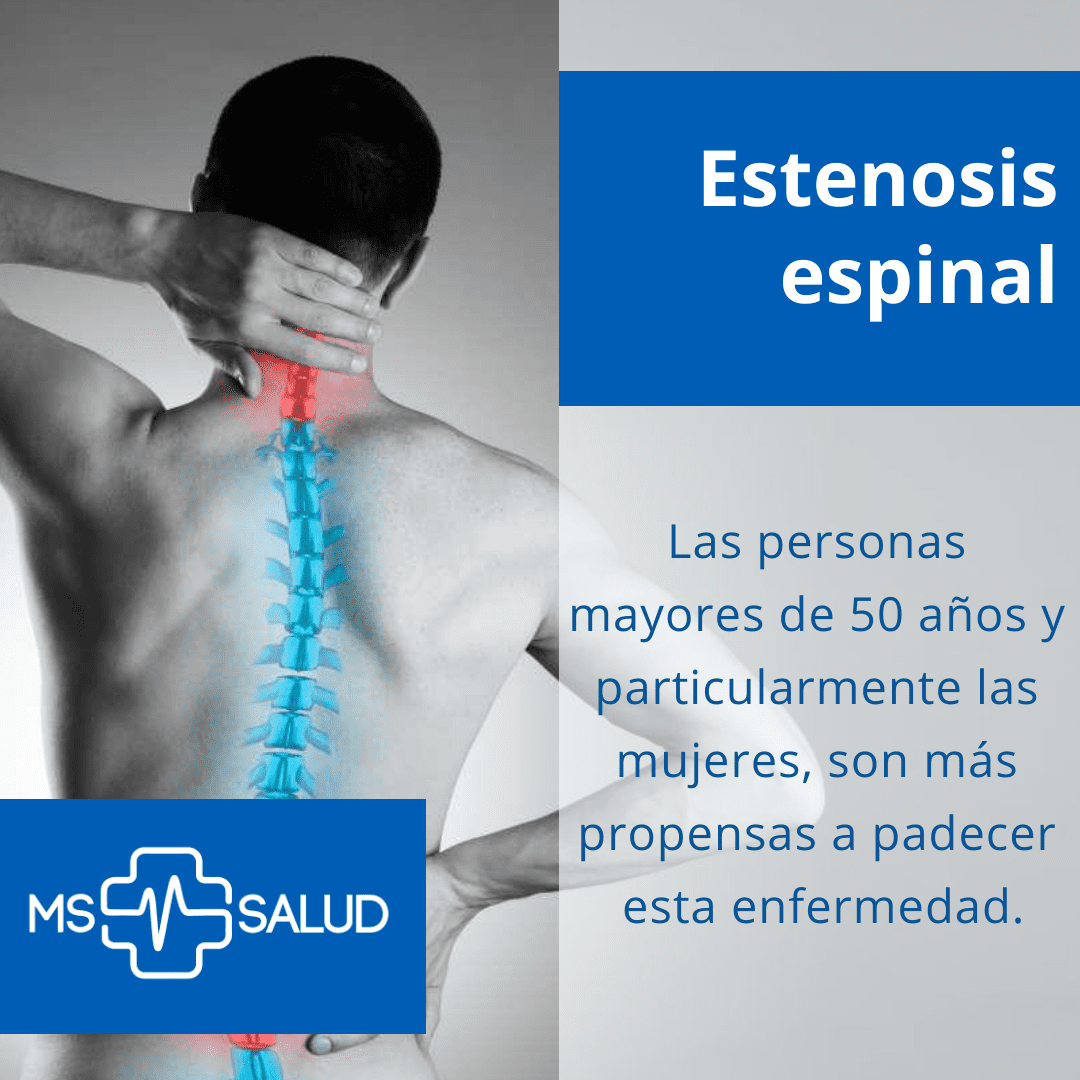 Estenosis Espinal Síntoma Causas Y Diagnóstico Ms Mas Salud 4344