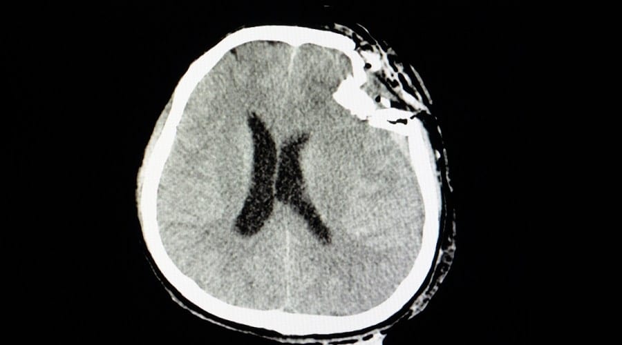 vinculan lesion cerebral traumatica mayor riesgo demencia min